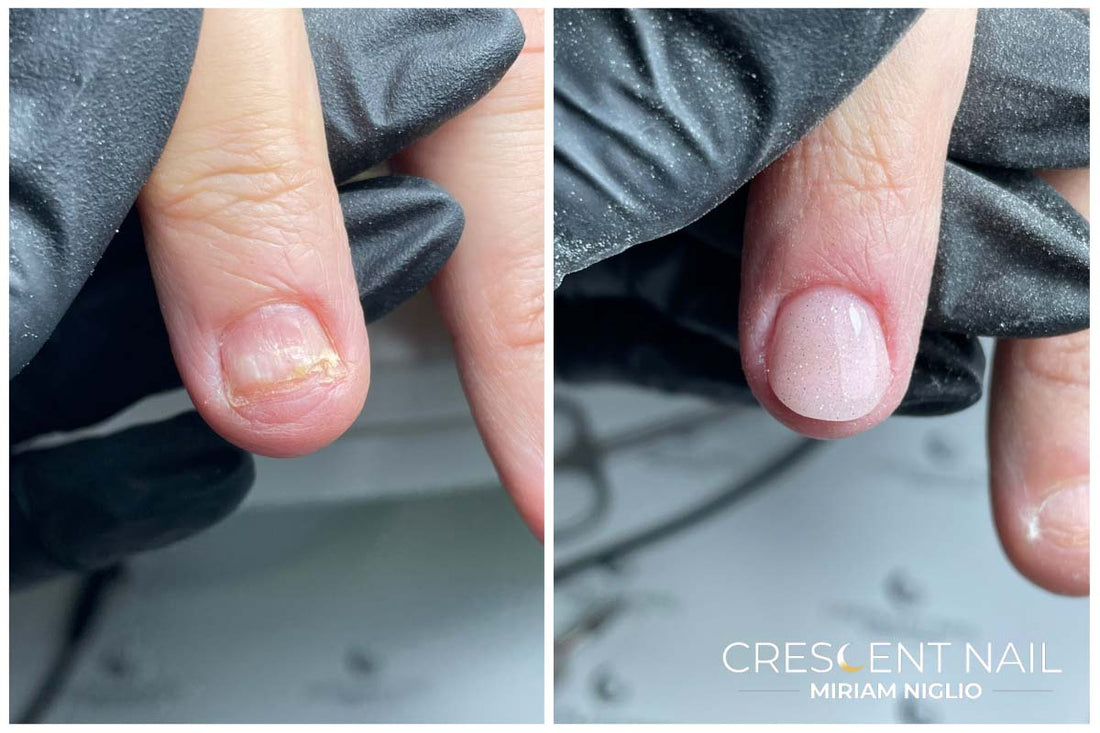 Rimedi Onicofagia Unghie: i migliori trattamenti Crescent Nail